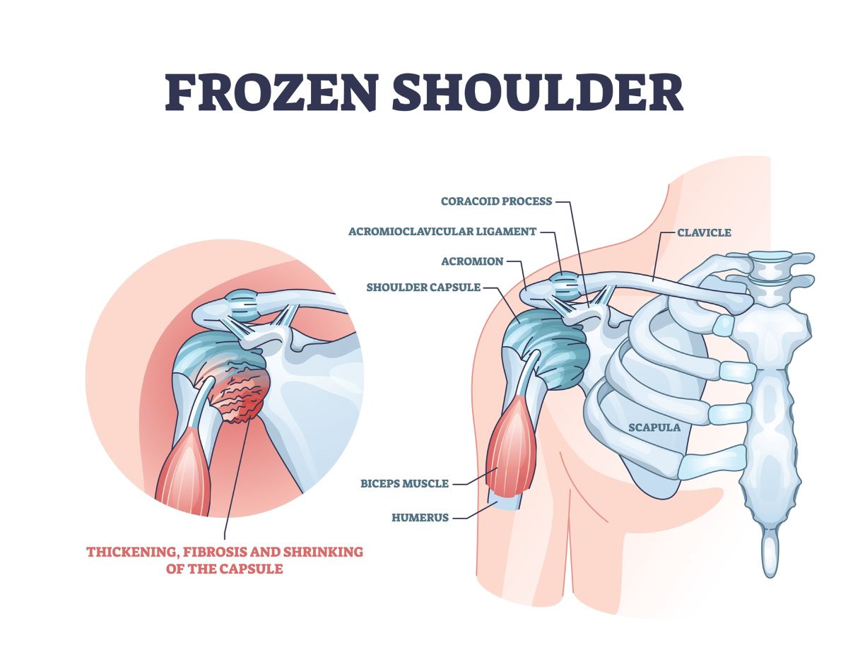 Imagine not being able to brush your hair, reach for a coffee mug, or put on a seat belt – everyday movements most of us take for granted. For millions of people suffering from frozen shoulder, th