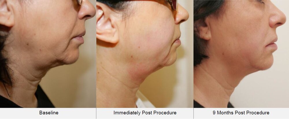 hifu treatment before and after neck