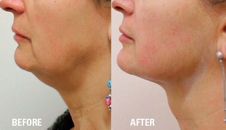 hifu treatment before and after neck 4