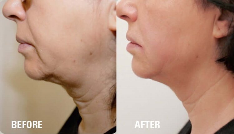 hifu treatment before and after neck 2