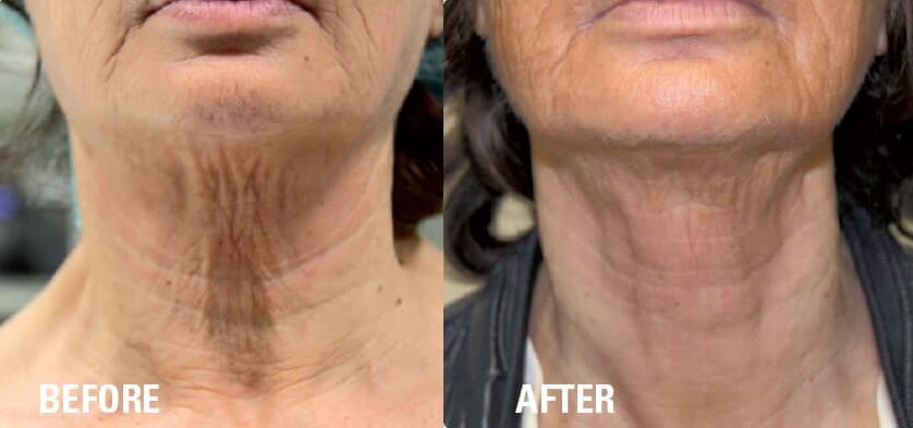 hifu treatment before and after neck 5