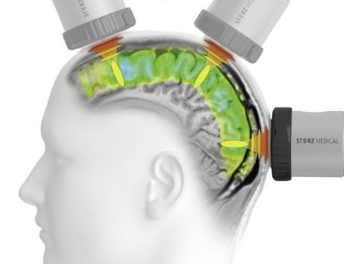 Transcranial Pulse Stimulation: A New Drug-Free Treatment for Alzheimer’s?